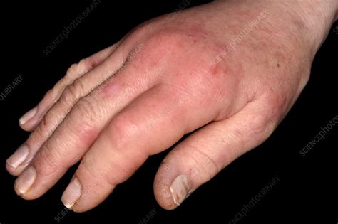 Cellulitis Finger Tip