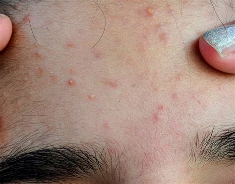 Managing Itchy Acne Symptoms Causes And Treatment