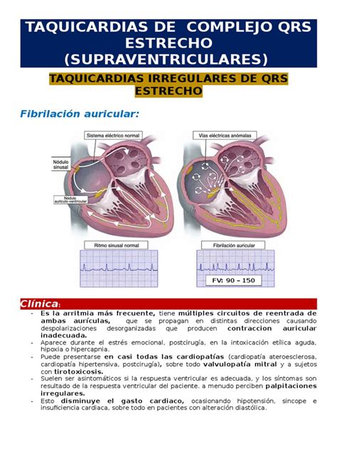 Taquicardias De Complejo Qrs Estrecho Irregulares Arritmia Cardiaca