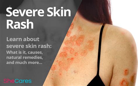 Severe Skin Rash Shecares
