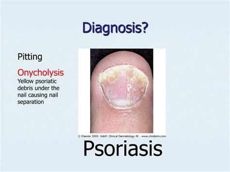 Ppt Onychomycosis Powerpoint Presentation Free Download Id1785081