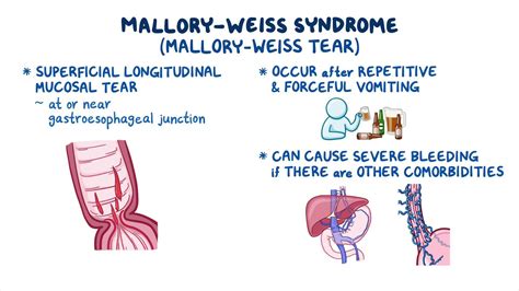 Mallory Weiss Syndrome Clinical Sciences Osmosis Video Library