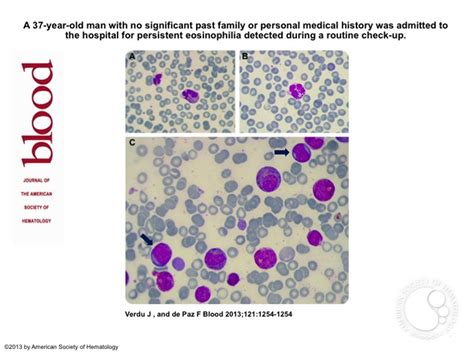 Chronic Eosinophilic Leukemia With Fip1l1 Pdgfra