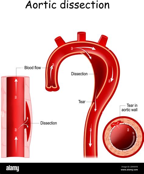 Aortic Dissection Injury To The Innermost Layer Of The Aorta Blood To