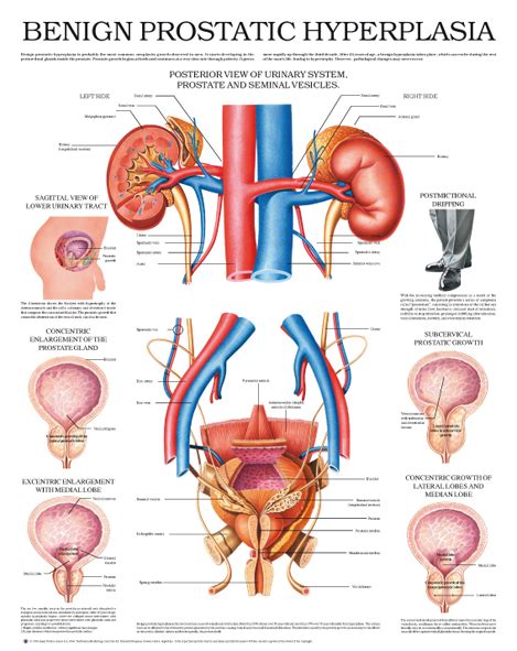 Benign Prostatic Hyperplasia Anejo