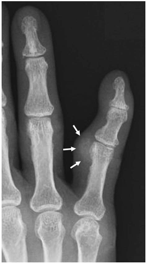 Calcifying Aponeurotic Fibroma Of The Finger In An Elderly Patient Ct