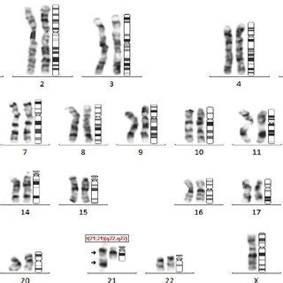 Down syndrome is caused by an abnormal cell division the karyotype is 46xx or 46xy with a translocation between a supernumerary chromosome 21 and. Shows G-banded karyotype of male Down syndrome with 47, XY, +21 | Download Scientific Diagram