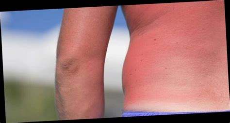 Skin may also feel warm or hot to the touch. Here's How Long It Takes to Heal That Scorching Sunburn ...