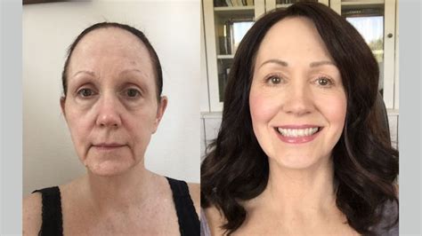 best facelift adding renuvion j plasma system skin resurfacing beats laser treatment for face