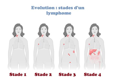 Les 7 Premiers Symptômes Dun Lymphome