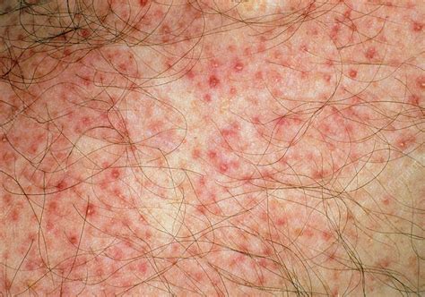 Close Up Of Red Folliculitis Papules On Skin Stock Image M1600044