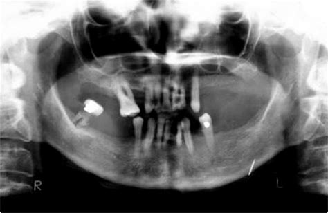 Opg Of Case 2 Revealing One Needle At The Left Lower Border Of The Body