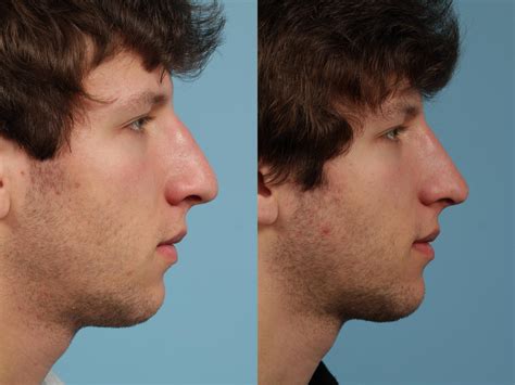 Rhinoplasty Before And After Photos Patient 139 Chicago Il Tlkm