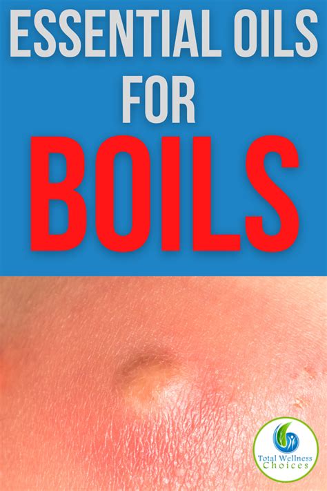 Top 5 Essential Oils For Boils In 2021 Essential Oil For Boils