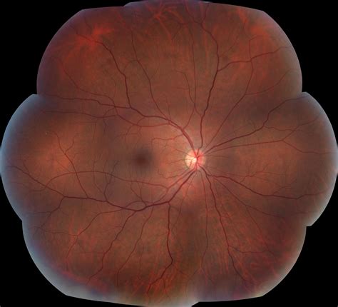 Fundus Photograph Reading Center Maintains Momentum Uw Dovs