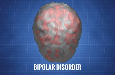 We explain the symptoms, diagnosis, treatment options, and more. Bipolar Disorder - Cerescan