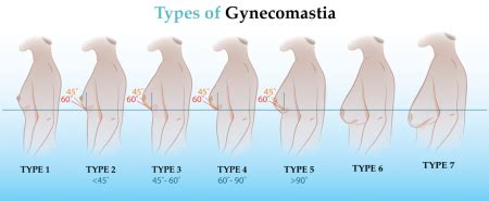 Gynecomastia Reading Berkshire Chiltern Medical Clinics