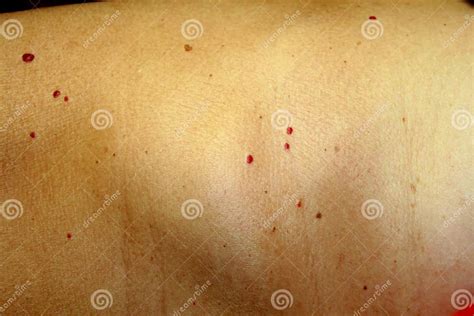 Angioma On The Skin Red Moles On The Body Many Birthmarks Stock