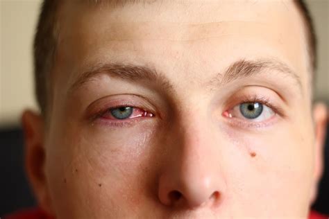 Pink Eye Symptoms Causes And Associated Complications