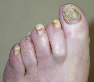 Causes of toe nail fungus. Nail Fungus Really | Fungal Toenail Cure
