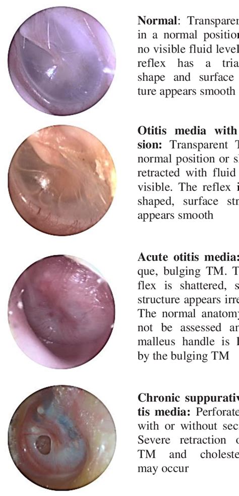 figure 2 from aids for otolaryngologists diagnostic evaluation of tympanic membranes semantic