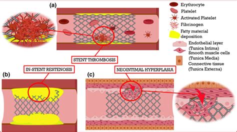 Perspectives On Smart Stents With Sensors From Conventional Permanent
