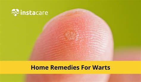 12 Home Remedies For Warts