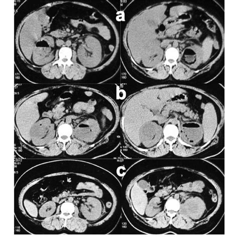 An Abdominal Ct Scan Showing Bilateral Epn A Diffusely Enlarged