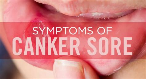 Canker Sore Getcured Apothecary Pvt Ltd