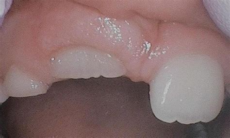 Tysons Dentistrys Smile Gallery Operculectomy For Permanent Tooth