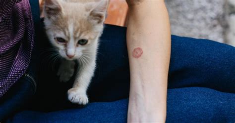 Itchy Red Circular Rash — It Could Be Ringworm