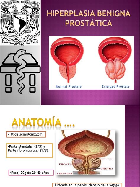 Hiperplasia Benigna Prostática Urología Especialidades Medicas