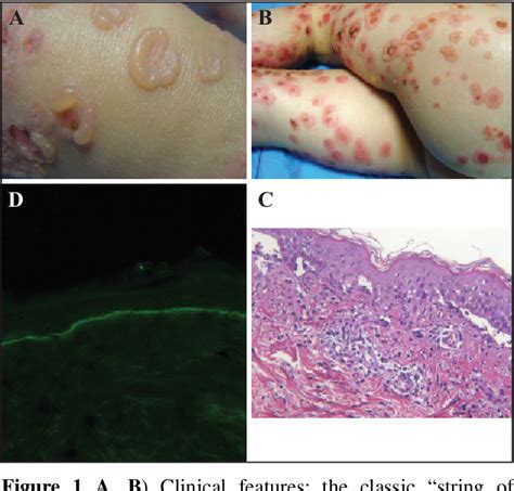 Figure 1 From Linear Iga Bullous Dermatosis In A Two Year Old Child