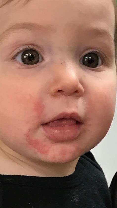 Allergy Trigger Red Rash On Childs Mouth