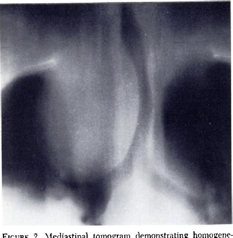 Figure 2 From Superior Vena Caval System Obstruction Caused By Benign