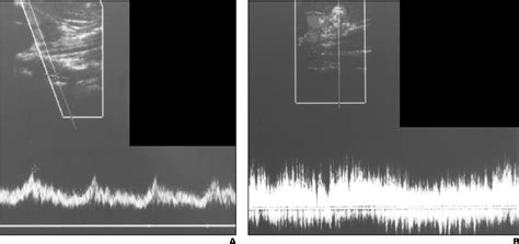 Figure 12 From A Spectrum Of Doppler Waveforms In The Carotid And