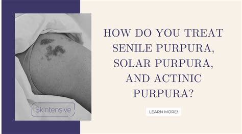How Do You Treat Senile Purpura Solar Purpura And Actinic Purpura