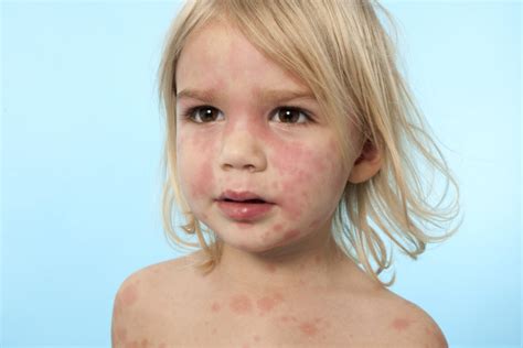 5 Rashes Your Child May Bring Home From Preschool Cleveland Clinic