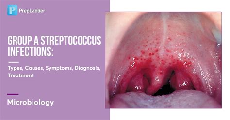 Group A Streptococcal Infections Types Causes Symptoms Diagnosis