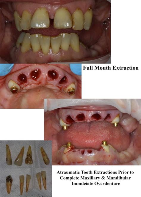 Pictures Of Tooth Extraction Healing Canvaaaaaaaa