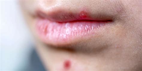 7 Tips To Make A Lip Pimple Disappear Quickly Business Insider India
