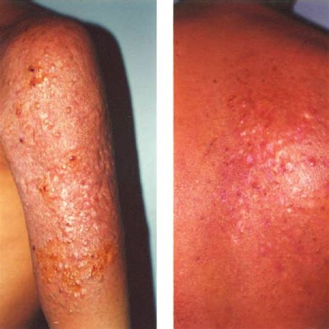 Papules Nodules And Erythematous Plaques Seen In The A Left Arm And