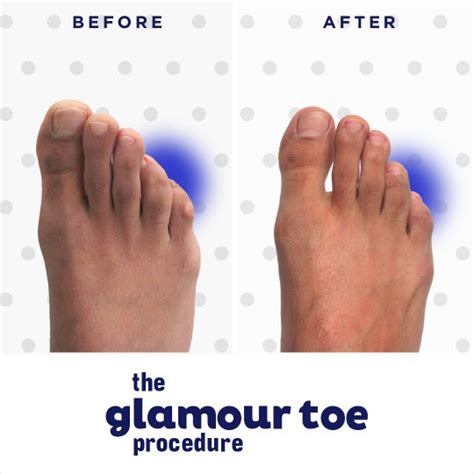 Hammer Toe Surgery Procedures In Nyc And Beverly Hills Dr Neal Blitz