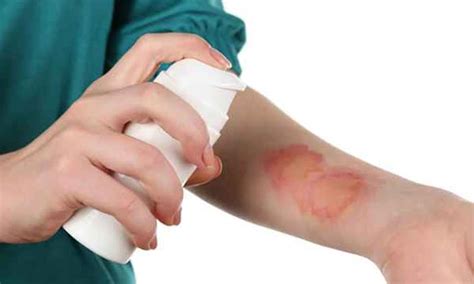 7 Tips For Taking Care Of Burns At Home Smart Health Shop