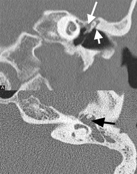 A B Coronal And Axial Images Of The Left Temporal Bone Show Soft