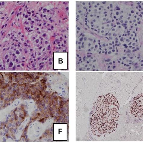 Histology And Immunohistochemical Staining Pattern Of Tumor Specimen