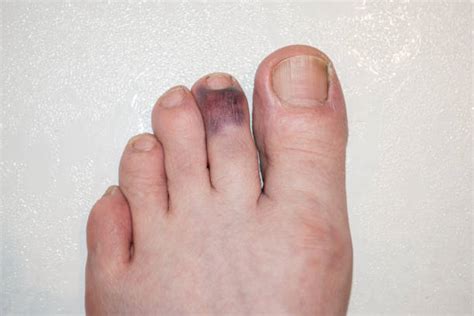 740 Bruised Toes Stock Photos Pictures And Royalty Free Images Istock