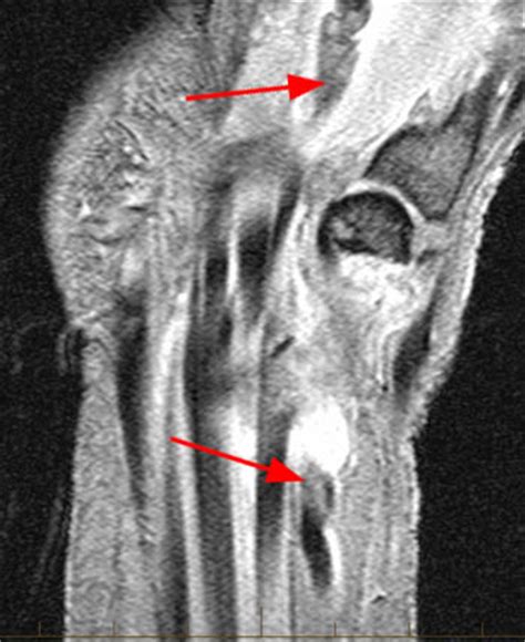 Tendinous interconnection in distal forearm between fpl tendon and index fdp tendon. Flexor Tendon Injuries - Radsource