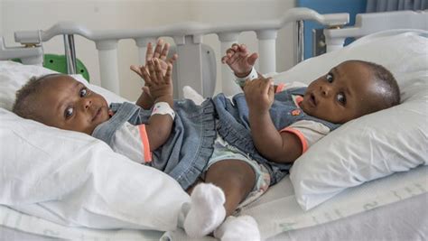 Conjoined Twins Separated In Memphis