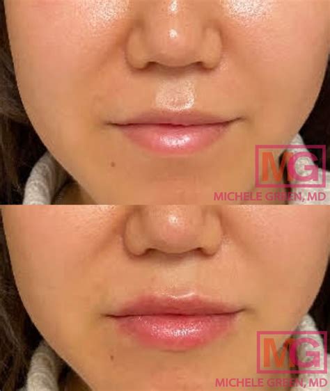 Vertical Lip Lines Best Fillers And How To Reduce Vertical Lip Lines